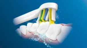 Curăţare excepţională între dinţi şi aparatul dentar